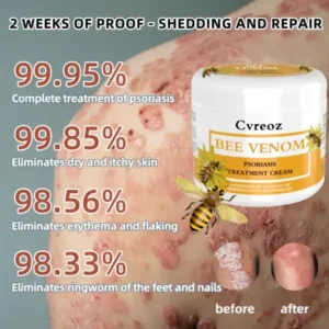 Cvreoz Bee Venom Psoriasis Treatmen