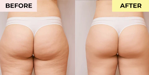 SKINNIER Tightening & Cellulite-Reducing Thigh Patch