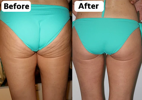 SKINNIER Tightening & Cellulite-Reducing Thigh Patch