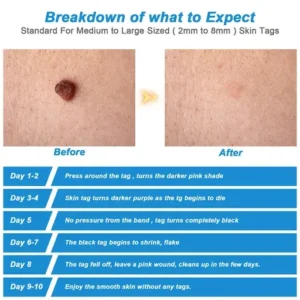 Skin Tag Removal Kit