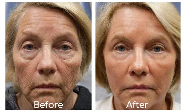 𝐒𝐩𝐳𝐯™ Botox Bienenvenom Faltenentfernungscreme